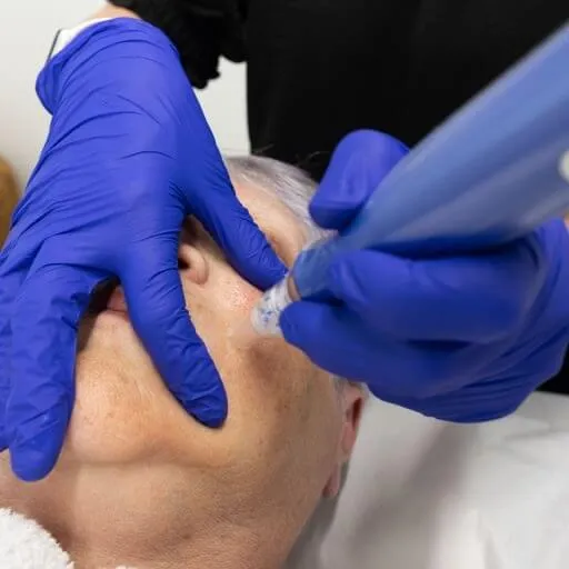 Microneedling treatment