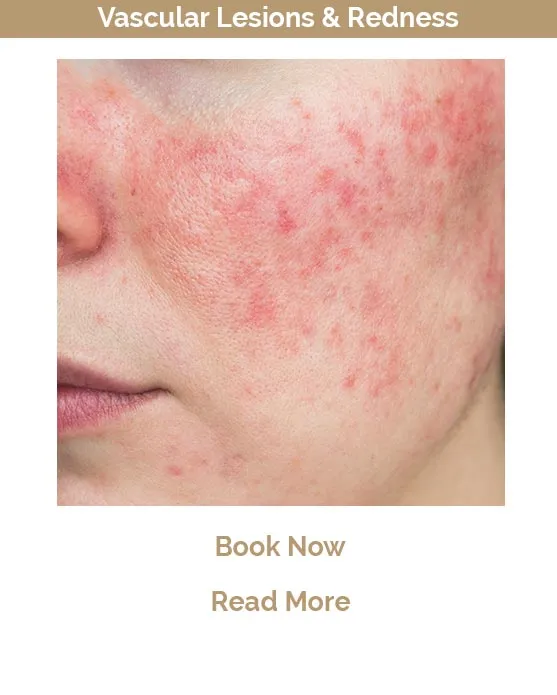 Rosacea and redness treatment Victoria B.C.