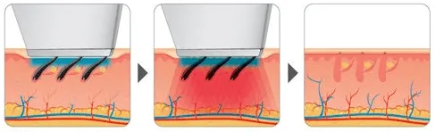 Laser Hair Removal Victoria B.C.